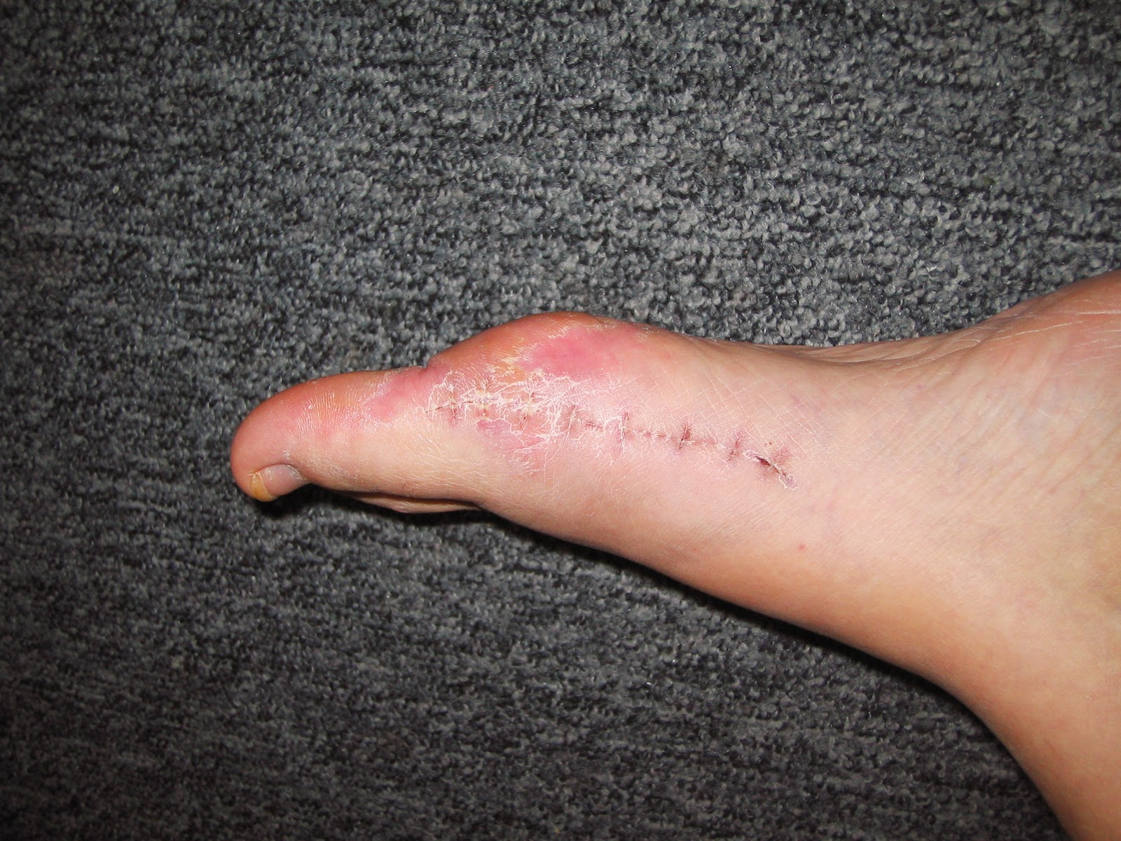 chaussures pied sensible hallux valgus