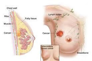 makanan yang dapat menyembuhkan kanker payudara, cara mengobati kanker payudara yg sudah pecah, pengobatan kanker payudara dengan lintah, indikasi kanker payudara, kanker payudara faktor keturunan, mengobati kanker payudara dengan daun sirsak, tumbuhan obat kanker payudara, kanker payudara nyeri, pengobatan alternatif kanker payudara stadium 4, cara penyembuhan kanker payudara stadium 4, klinik pengobatan kanker payudara, obat alternatif untuk kanker payudara, mengobati kangker payudara secara tradisional, kanker payudara rambut rontok, obat kangker payudara secara alami, biaya operasi kanker payudara stadium 1, kanker payudara stadium lanjut, tumbuhan herbal untuk kanker payudara, apa gejala awal kanker payudara, ramuan untuk pengobatan kanker payudara, kanker payudara terbaru, kanker payudara cara mendeteksi, kanker payudara keturunan, kanker payudara bagi laki-laki, kanker payudara menurut depkes, obat kanker payudara yg sudah pecah, kanker payudara bolehkah menyusui