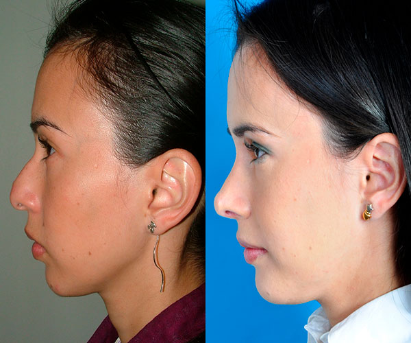 Consejos para recuperar de una rinoplastia