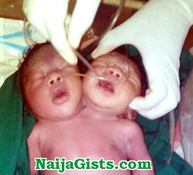 conjoined twins born with 2 head & 1 body