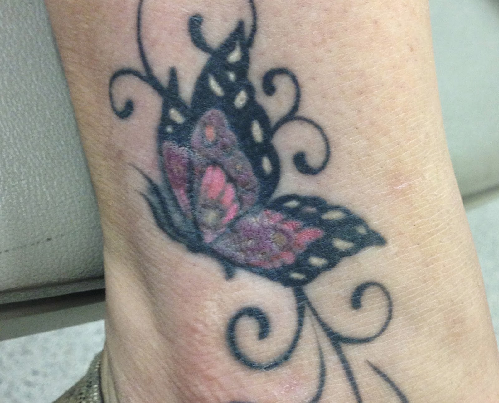 Tattoo Reactions: Allergic Contact Dermatitis By David Robles, MD, PhD