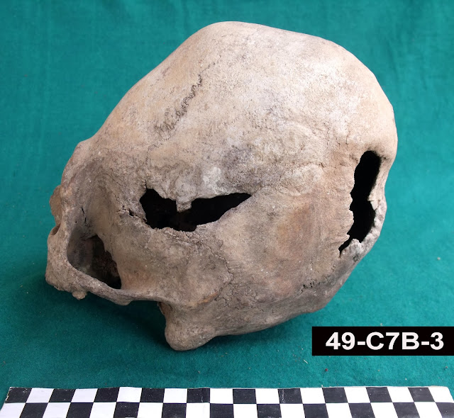 Bioarchaeology of Ancash: Skull Trepanations