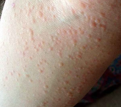 Những nốt nhỏ nổi trên da của bệnh mề đay mẩn ngứa