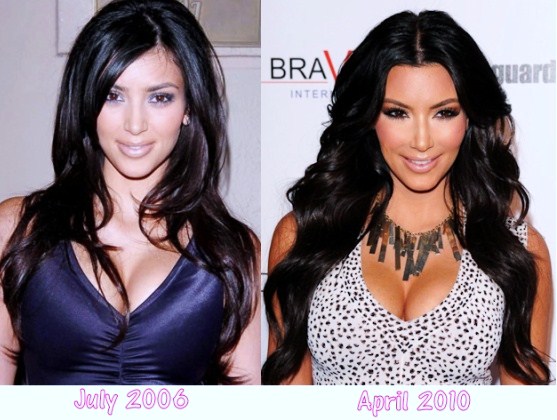 photos of nicki minaj before and after surgery. 2010 nicki minaj before after.