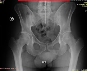 dolor perineal rey dolor perineal rey
