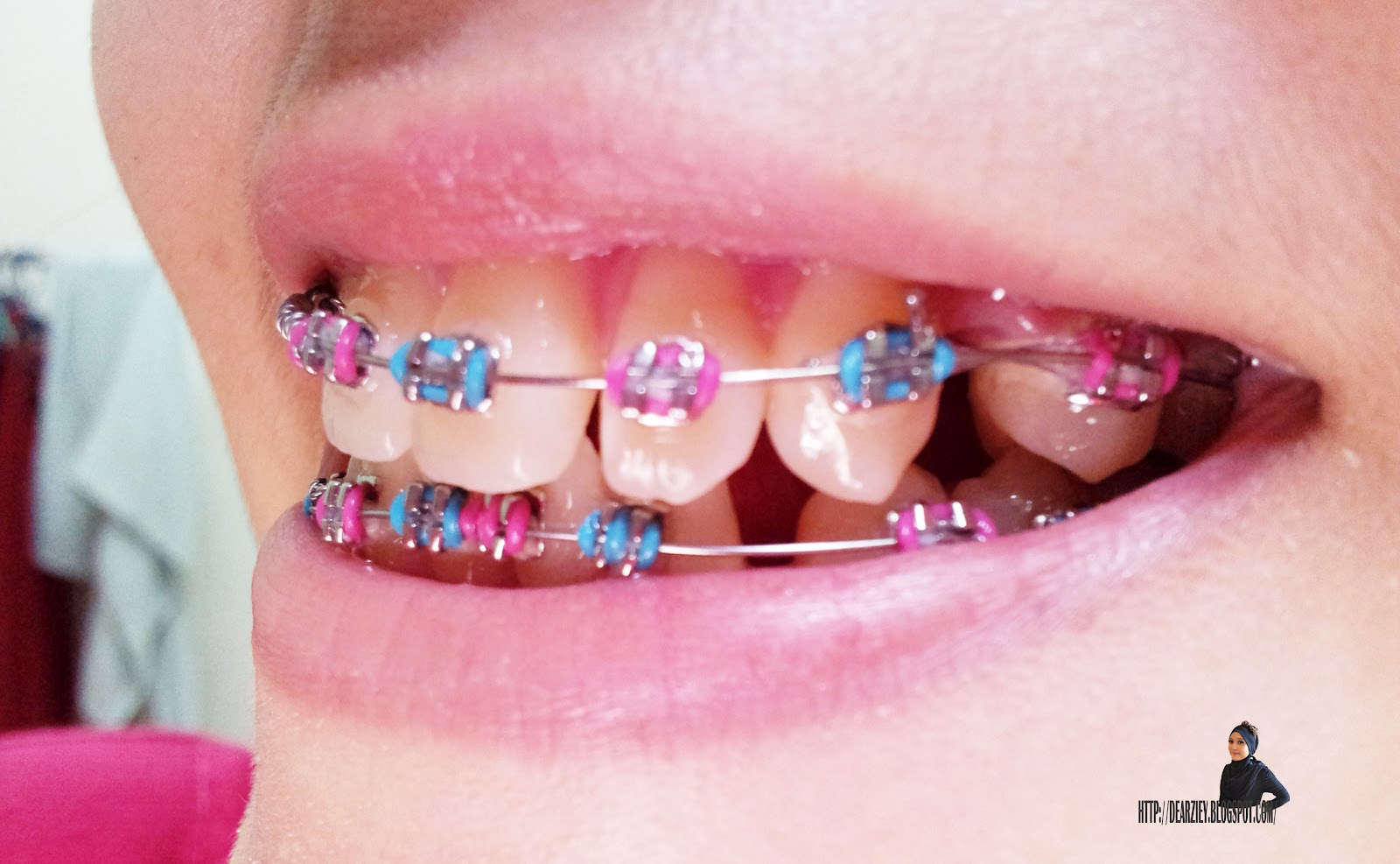 . me & braces 4 & 5 bulan di dakapan besi