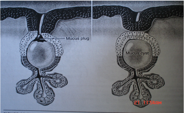 Mucous Cyst on Lip - Pictures, Causes, Treatment, Home ...