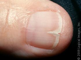 treatment nail ridges - awesome