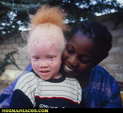 crianças albinas africanas