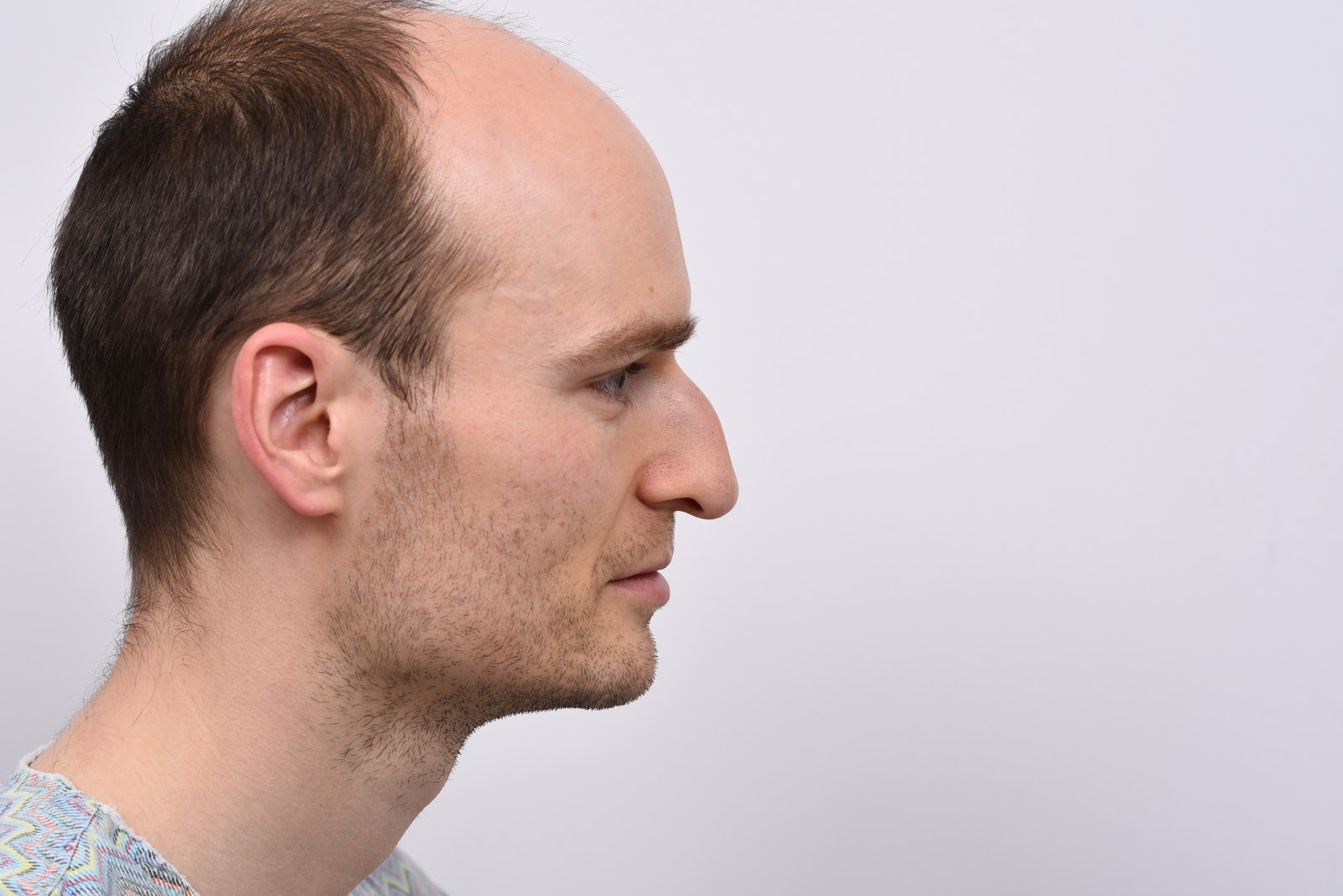 gng-plastic-surgery-hospital-paul-s-hump-nose-correction-at-gng-hospital