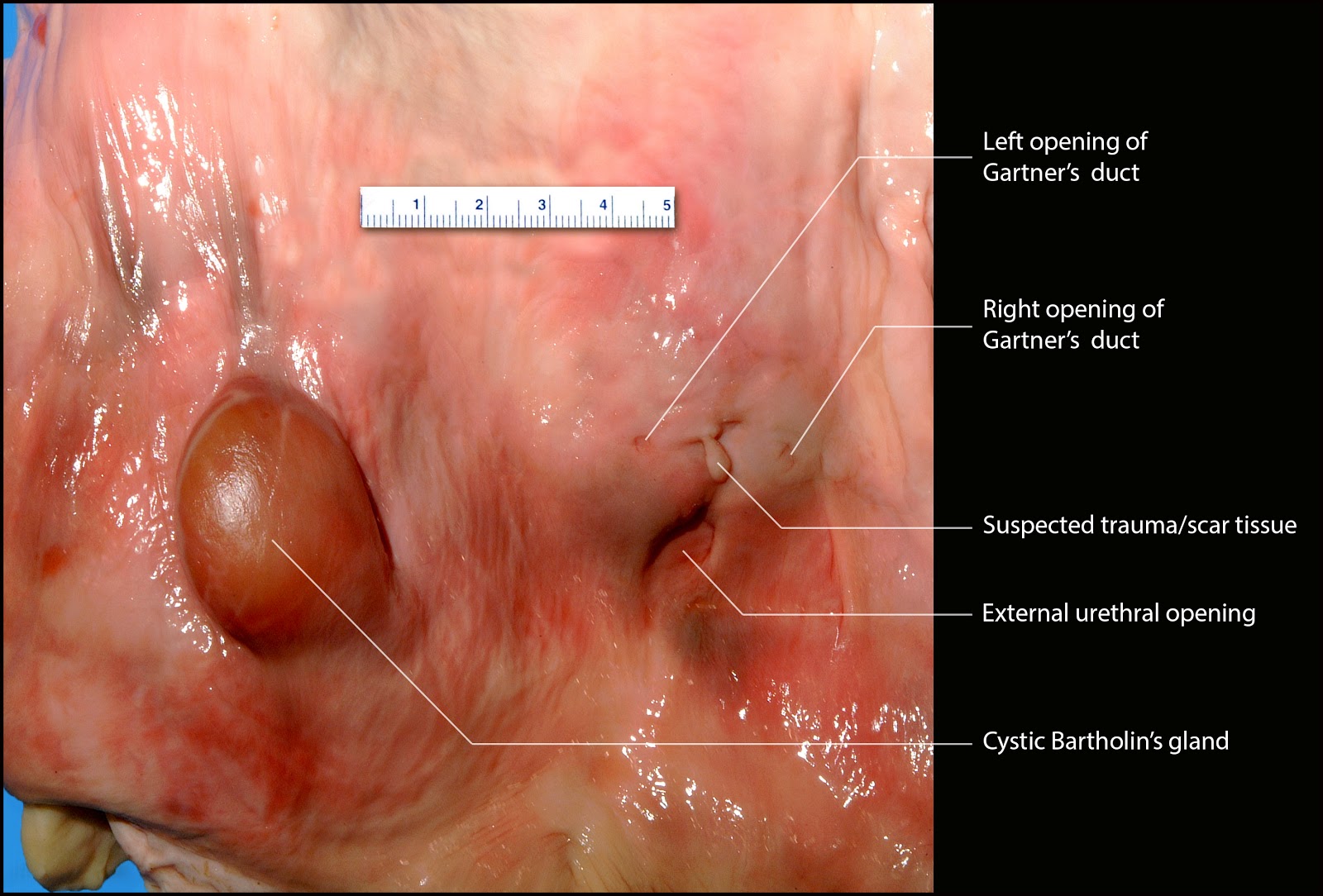 Vestibular glands vulva diagram pic 113