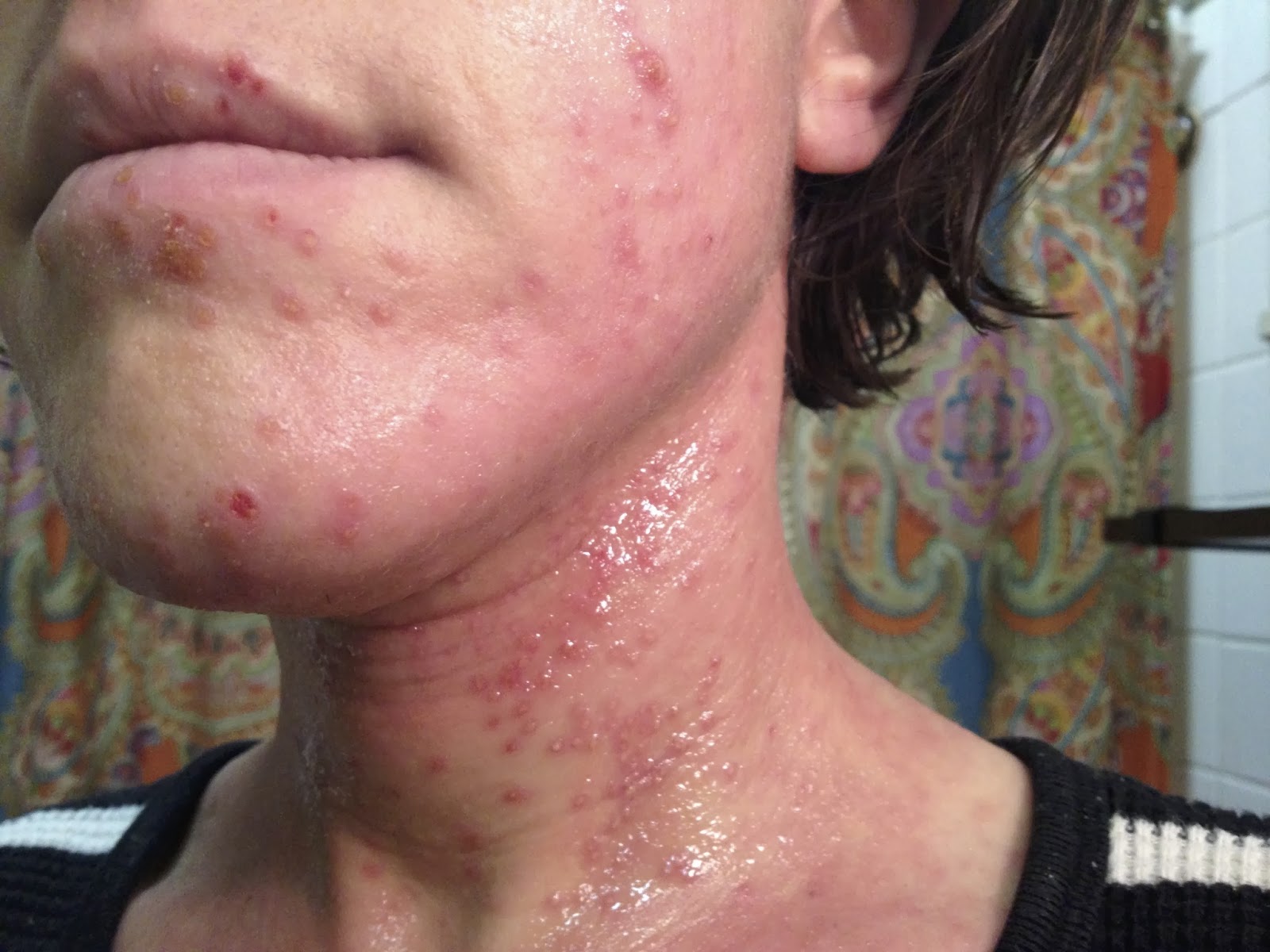 My journey with itchy skin.: Remember that one time: Eczema Herpeticum