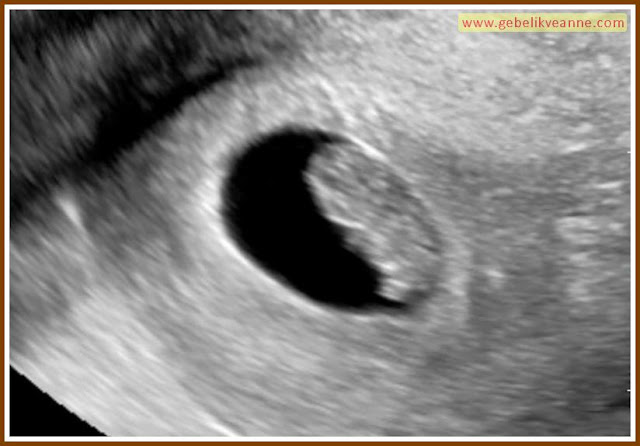 9 Haftalık Gebelik Ultrason Görüntüleri