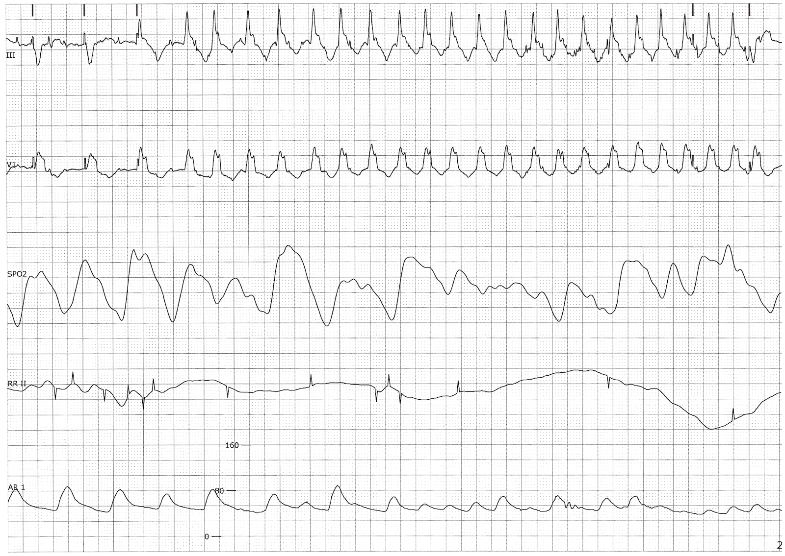 Ventricular Tachycardia with a Significant Drop in the Arterial Blood