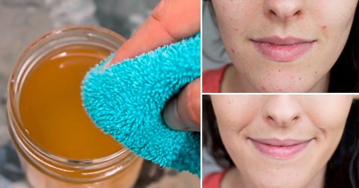 Put Apple Cider Vinegar on Your Face And See What Happens To Toxins