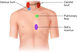 Venous hum Definition, Symptoms, Causes, Sound, Treatment