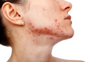 Adult acne and hormonal imbalances