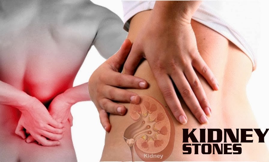 natural remedy for kidney stones