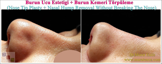 Burun Ucu Estetiği + Burun Kemeri Törpüleme (Nose Tip Plasty + Nasal Hump Removal Without Breaking The Nose)