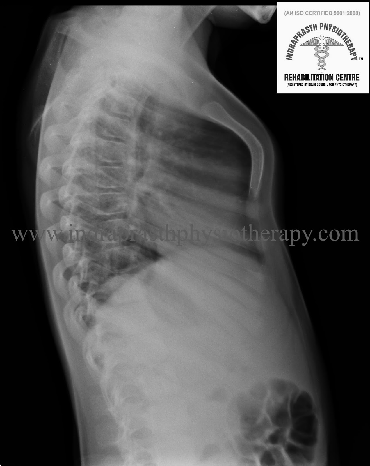 INDRAPRASTH PHYSIOTHERAPY CENTRE PIGEON CHEST (PECTUS CARINATUM)