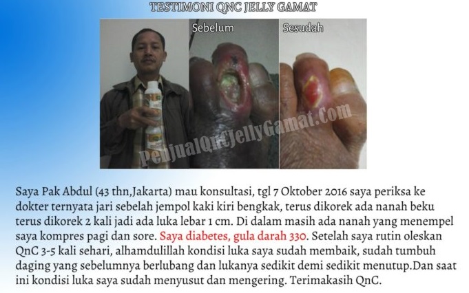 Cara Menyembuhkan Luka Borok Bernanah Dan Berair Secara Alami ~ Testimoni QnC Jelly Gamat Cara Menyembuhkan Luka Borok Bernanah Dan Berair Secara Alami ~ Testimoni QnC Jelly Gamat