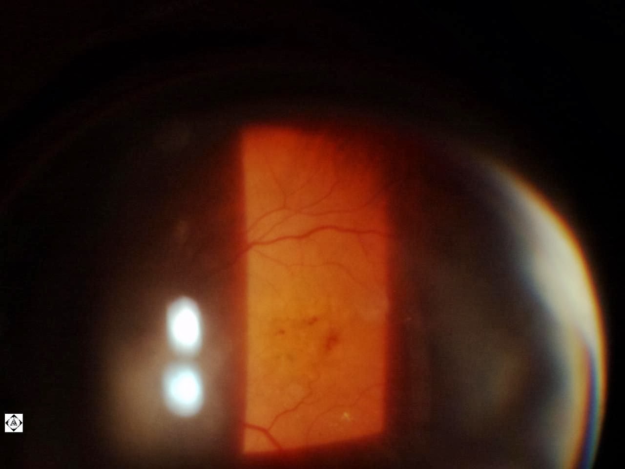 Sonoran Desert Eye Center WET MACULAR DEGENERATION