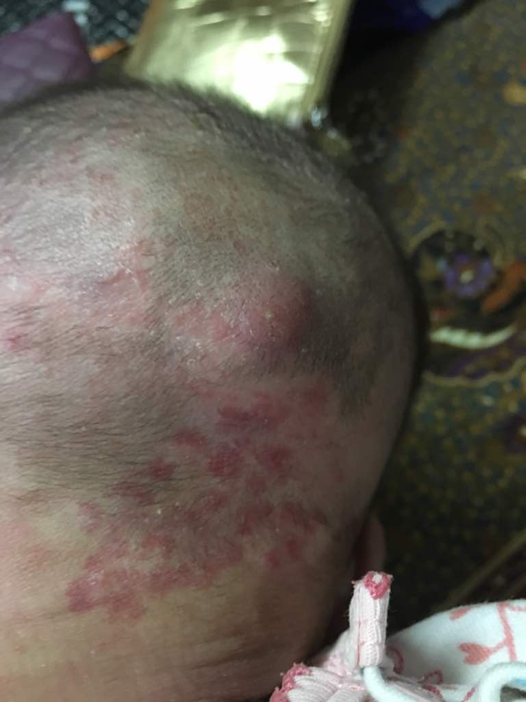 washura: Nadyne ada bisul besar di kepala