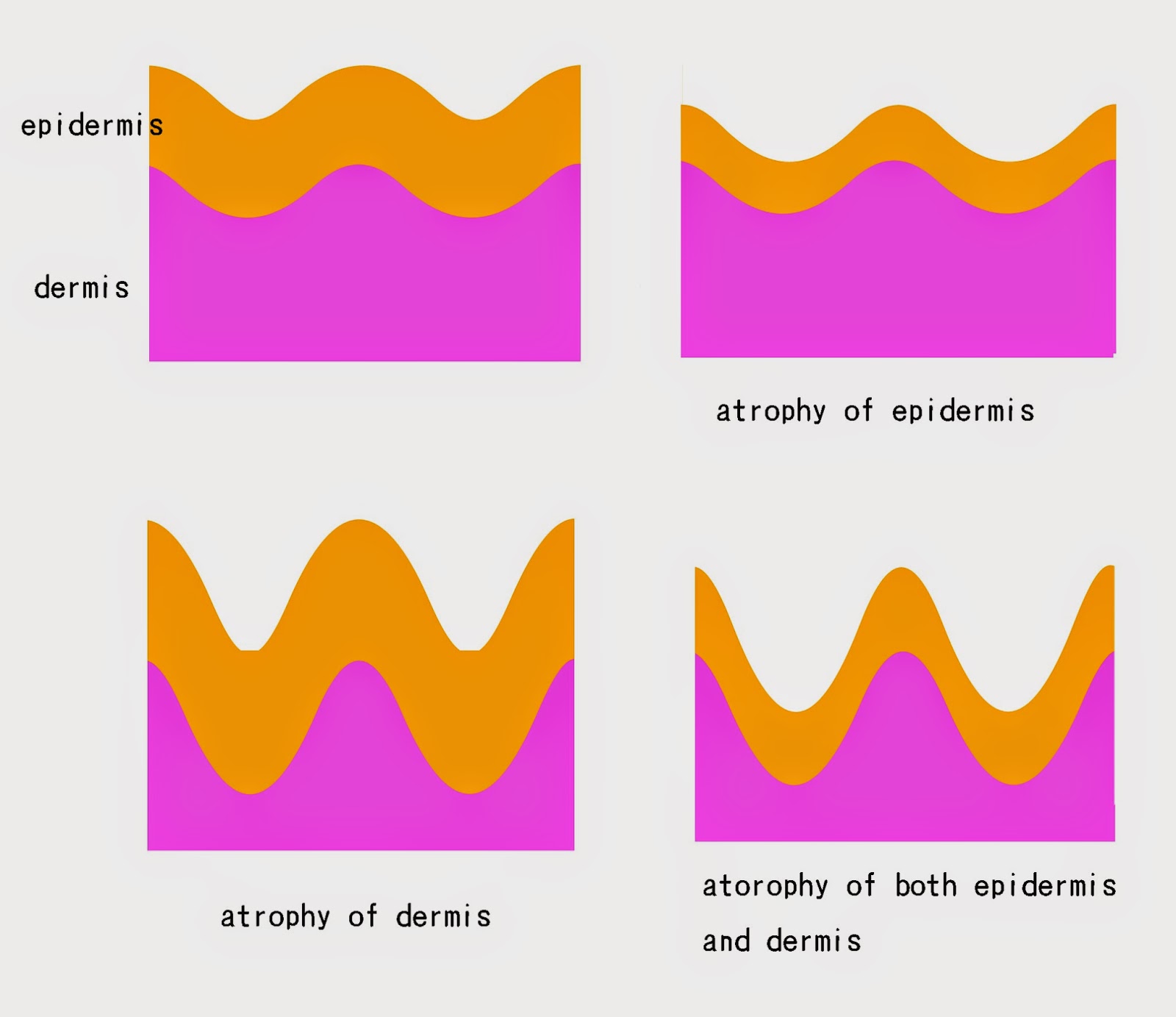 Cutaneous Atrophy Dr. Fukaya's blog about TSA (Topical Steroid Addiction)