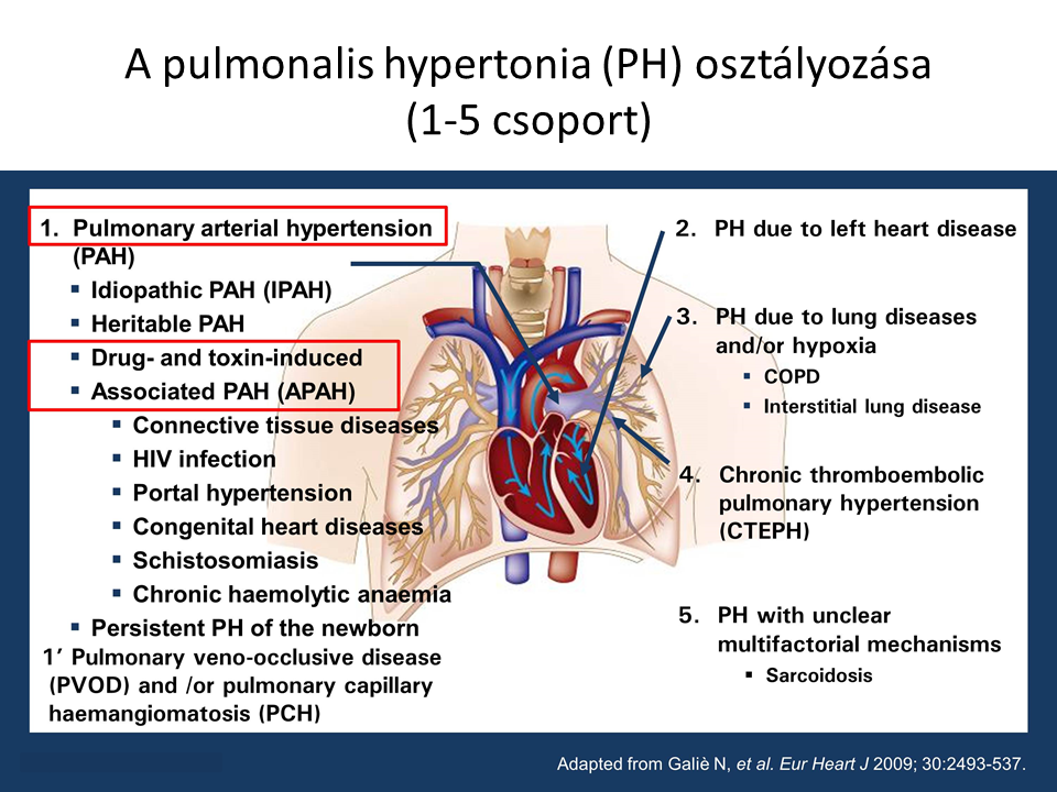 pulmonalis vénás hipertónia