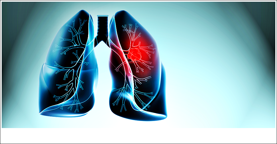 akciger kanseri blogger