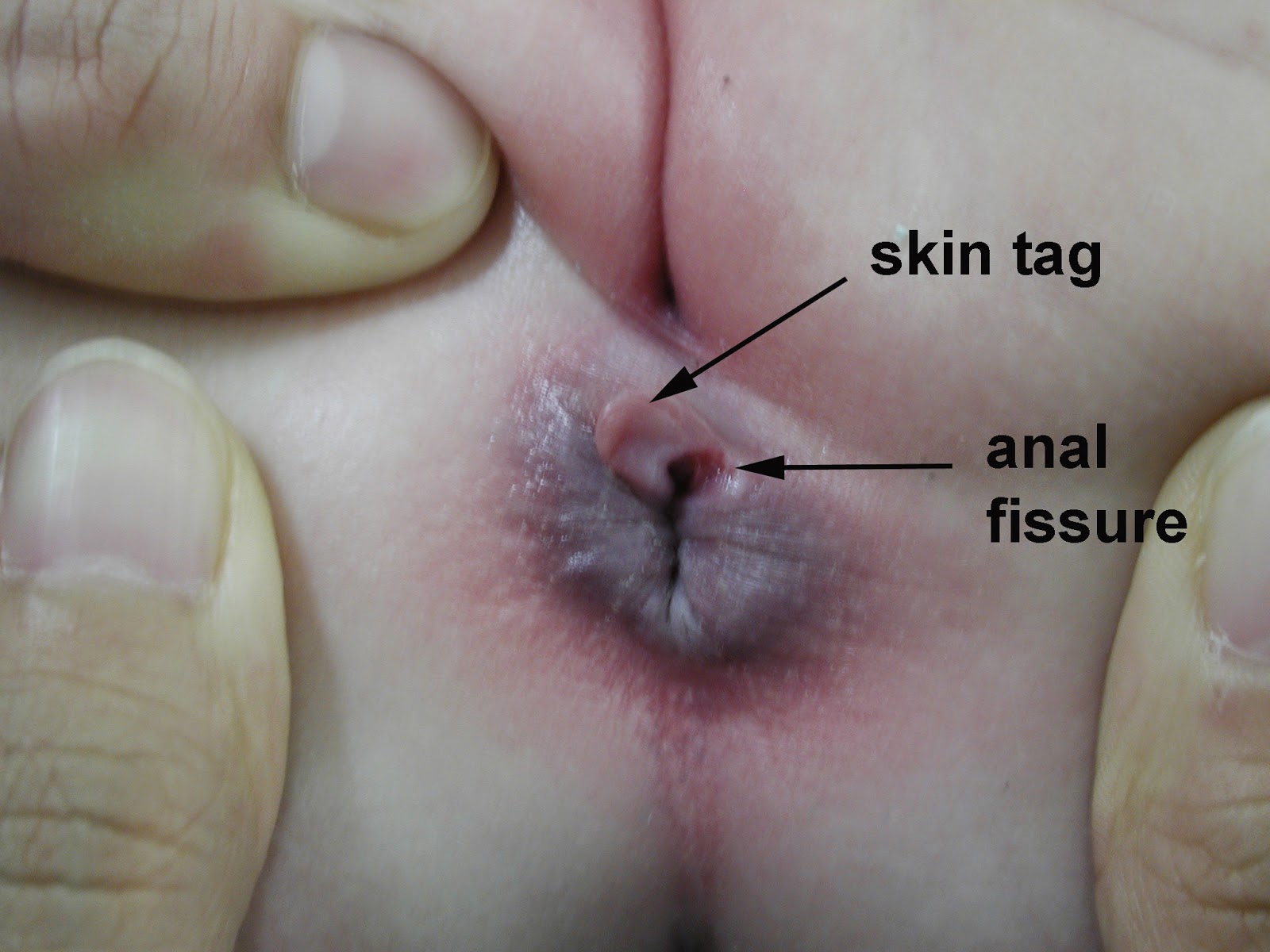     Anal Fissure The anal fissure is a small tear in the lining of the anus. The anal fissure can cause pain, bleeding and/or itching. Most fissures occur along the mid-line - the top or bottom - of the anus.  Causes of Anal Fissure  The anal fissure usually develops when the anal tissue is damaged during a hard and dry bowel movement which tears the anal lining.  The anal fissure can also develop due to higher than normal pressure in the anal sphincters. Diarrhoea and inflammation of the anorectal area can also cause an anal fissure.  Many women during childbirth develop an anal fissure.   Other causes of the anal fissure are:  • Digital insertion (during examination),  • Foreign body insertion,   • Anal intercourse.  In some cases, the anal fissure may be caused by other health conditions, such as:  • Vitamin B-6 deficiency,  • Abdominal pain,  • Fever,  • Weight loss,  • Crohn's disease,  • Inflammatory bowel disease (IBD) that causes bloody diarrhoea,  • Syphilis, a suppressed immune system,  • Tuberculosis,  • HIV infection,  • Anal cancer.  • A low fibre diet may also contribute to the development of a fissure.  Symptoms of Anal Fissure • Sharp, stinging or burning pain during and following a bowel movement.  • Spots of bright red blood on toilet tissue. This blood is separate from the stool. Blood mixed with the stool indicates some other conditions (like colon cancer and inflammatory bowel disease).  • Itching and malodorous discharge may also occur.  Anal Fissure Treatment  Symptomatic Homeopathy works well for Anal fissure, It helps to prevent further recurrence also. So its good to consult a experienced Homeopathy physician without any hesitation.    Whom to contact for Anal Fissure Treatment  Dr.Senthil Kumar Treats many cases of anal fissure, In his medical professional experience with successful results. Many patients get relief after taking treatment from Dr.Senthil Kumar.  Dr.Senthil Kumar visits Chennai at Vivekanantha Homeopathy Clinic, Velachery, Chennai 42. To get appointment please call 9786901830, +91 94430 54168 or mail to consult.ur.dr@gmail.com,    For more details & Consultation Feel free to contact us. Vivekanantha Clinic Consultation Champers at Chennai:- 9786901830  Panruti:- 9443054168  Pondicherry:- 9865212055 (Camp) Mail : consult.ur.dr@gmail.com, homoeokumar@gmail.com   For appointment please Call us or Mail Us  For appointment: SMS your Name -Age – Mobile Number - Problem in Single word - date and day - Place of appointment (Eg: Rajini - 99xxxxxxx0 – Psoriasis – 21st Oct, Sunday - Chennai ), You will receive Appointment details through SMS