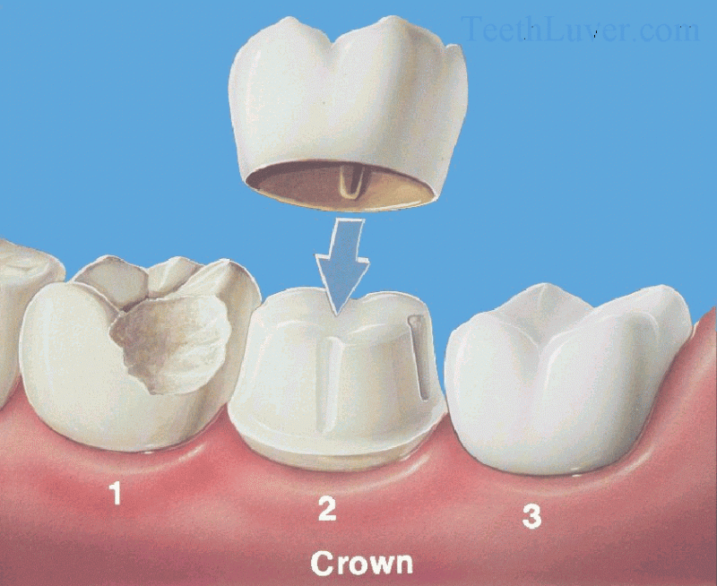 Dentistry and Medicine Anterior PMF(Porcelain Fused to Metal) Crown