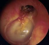 Lunar Otitis Media Alias Congek Curek