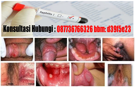 Obat Sipilis Antibiotik Obat Sipilis Antibiotik