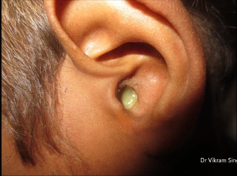 التهاب-فطري-بالأذن-كتلة-فطرية