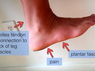 PLANTAR FASCIITIS with Get Rid Of The Foot Pain reviews