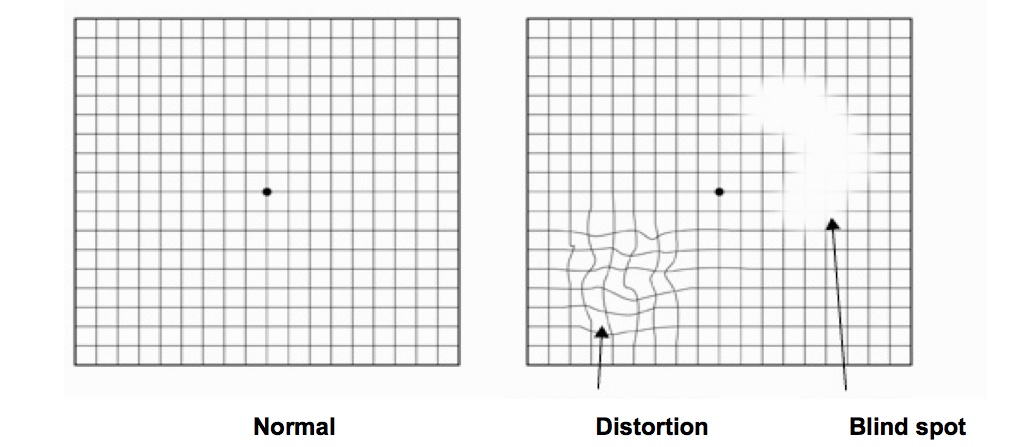  amsler grid distortion examples 