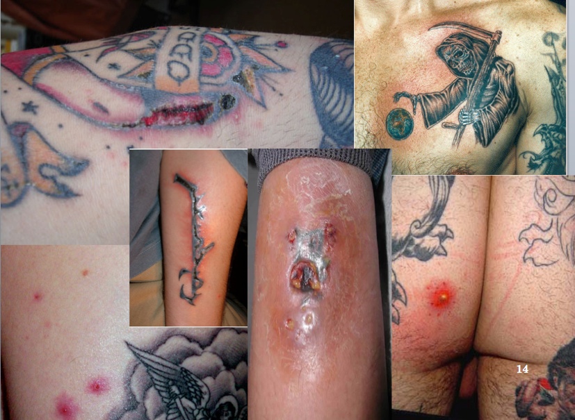 Biogeomundo: Enfermedades causadas por los tatuajes