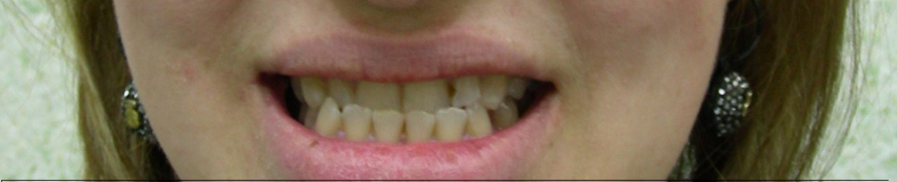 Dr.George E. Bardawil-Orthodontist-Invisalign Diamond level : CLASS 3