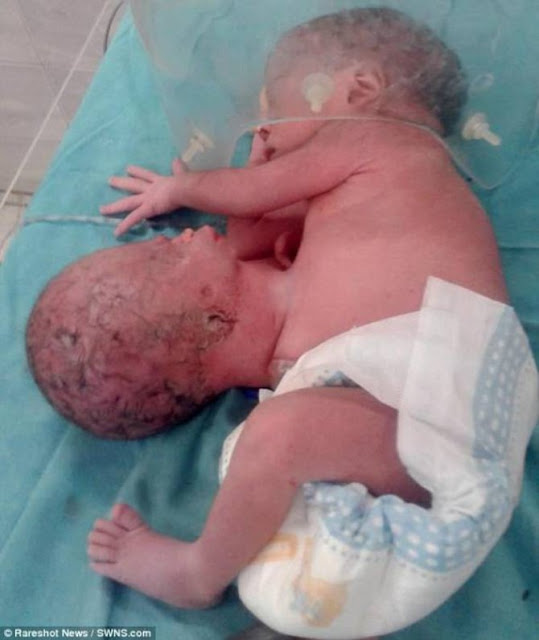 Kepala Bayi Kedua Tumbuh Diperut, Tak Disangka Saat Di Bedah Yang Terjadi Mengejutkan!  Kepala Bayi Kedua Tumbuh Diperut, Tak Disangka Saat Di Bedah Yang Terjadi Mengejutkan!
