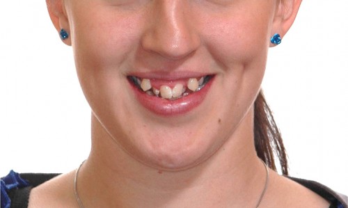 Răng mọc thừa bị lung lay có nên nhổ không?