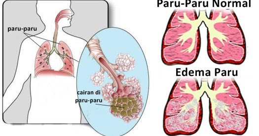 Cara Mengobati Edema Paru Secara Alami ~ Obat Bronkitis Pada Anak