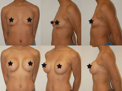 Antes e Depois Mamoplastia de Aumento Antes e Depois Mamoplastia de Aumento