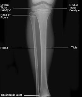Radiographic positioning: Tibia Fibula