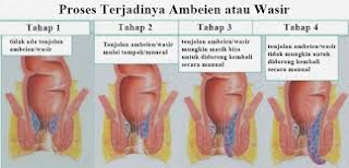 Obat Untuk Sakit Ambeien Berak Darah Yang Bagus