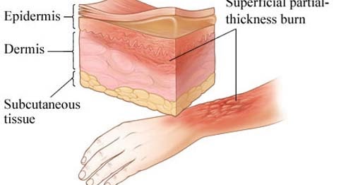 how long does it take for a blister to heal how long does it take for a blister to heal