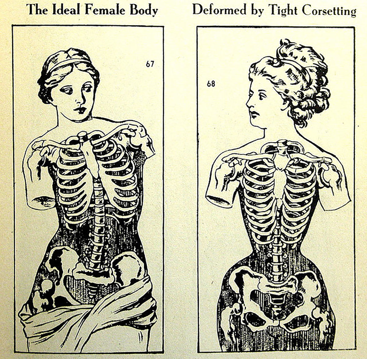 deformação das costelas, corseting, espartilho, corpete