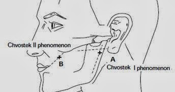 What I learned today...: For your information... Chvostek's and ...