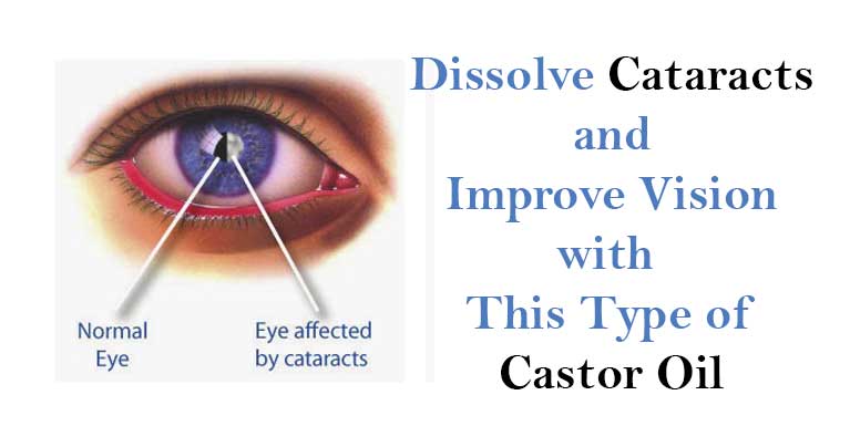 Terra Forming Terra How To Remove A Cataract And Get 20 20 Vision With Castor Oil