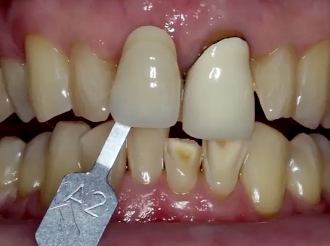 PROSTHODONTICS: A New Smile - Restoring the Anterior